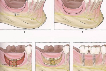 پیوند بلوک استخوان ایمپلنت | روش پیوند بلوک استخوان ایمپلنت 