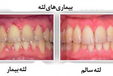 علائم سالم و ناسالم بودن لثه | تشخیص سالم و ناسالم بودن لثه