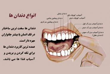 دندان کرسی | خرابی دندان کرسی