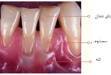 سمنتوم دندان | ارتودنسی سمنتوم