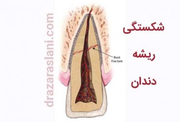 شکستن ریشه دندان | کامل در نیامدن ریشه دندان